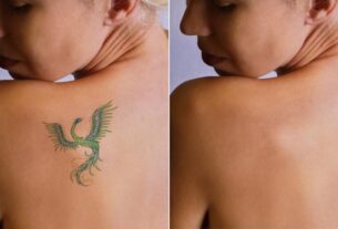 The Secret of TATTOO REMOVAL